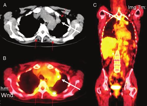 FDG-PET scan identification of a primary lung carcinoma in a patient ...