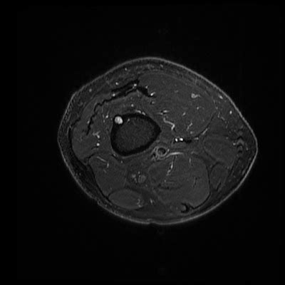 Radiology Cases: Fibrous Cortical Defect