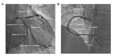 Coronary angiography - Centre de Cardiologie Interventionnelle Belledonne