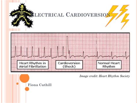 Electrical Cardioversion — learnED