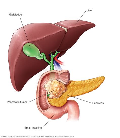 What You Need To Know About Pancreatic Cancer - KompleteCare Blog