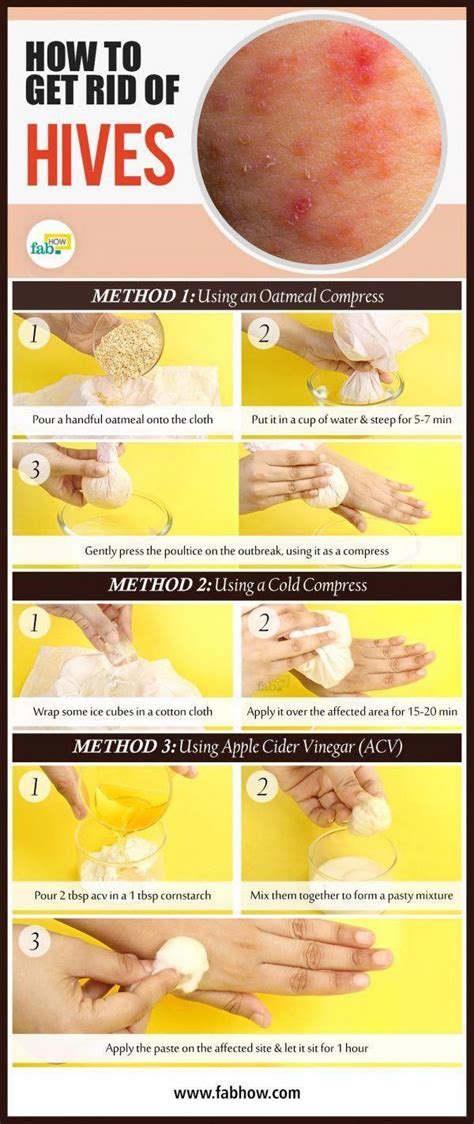 How to Get Rid of Hives Naturally with These Home Remedies # ...