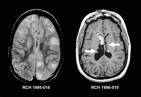 Brain Mri With Contrast | Hot Sex Picture