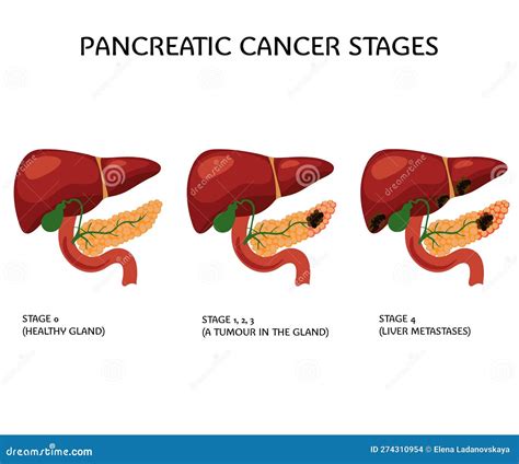 Pancreatic Cancer Stages Pancreas Medical Poster Stock Vector ...