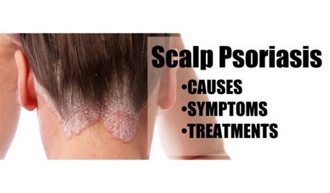 Psoriasis Scalp Types