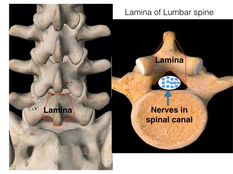 Lumbar laminectomy - Indications, results and cost - neurosurgerypro.com