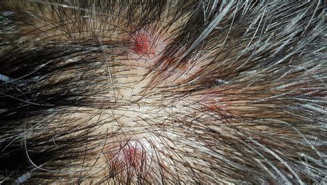 Scabs On The Scalp, wound on the scalps or Lichen planus follicularis ...