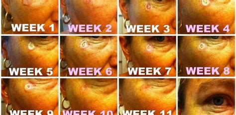 Chemo Rash On Face