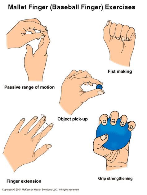 Sports Medicine Advisor 2003.1: Mallet Finger Exercises: Illustration