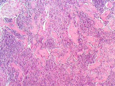 HISTOPATHOLOGY: Mesenteric lymph nodes