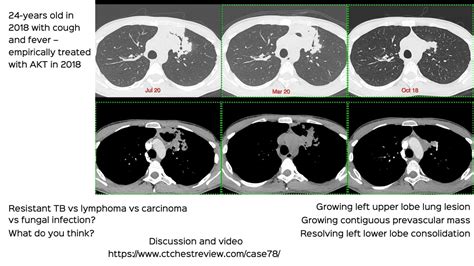 Lung Mass - CT Chest Review