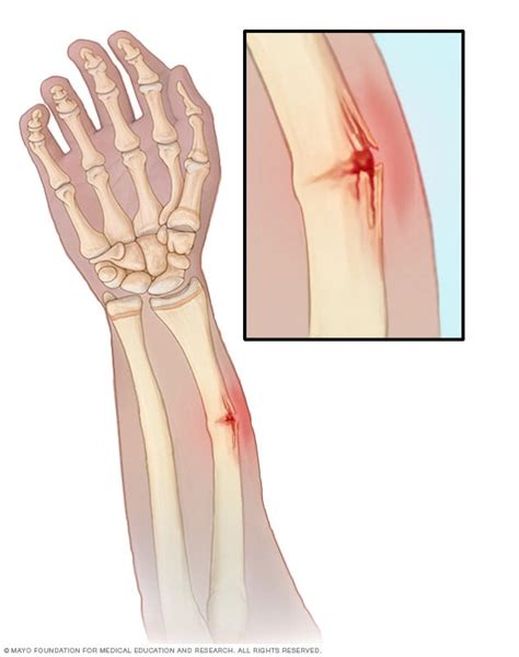 Greenstick fractures - Symptoms and causes - Mayo Clinic