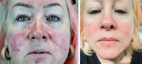 rosacea before and after | Beauty And The Brows