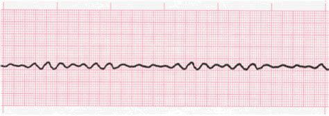 Ventricular Fibrillation - EKG Lesson #315