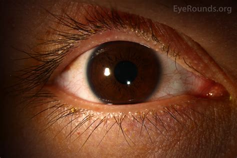 Atlas Entry - Phlyctenular Conjunctivitis