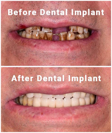 Patient Stories about Dental Implants | Premium Choice Dental