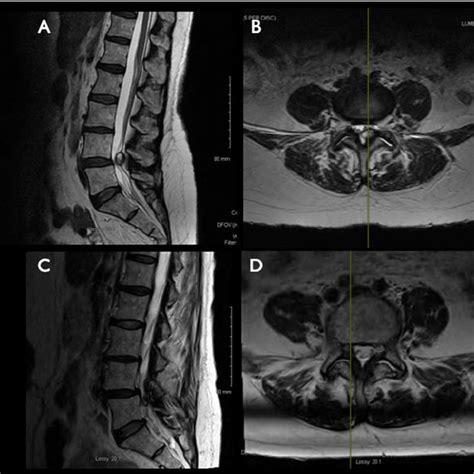 Example of a “ ligamentum flavum cyst ” adjacent to the left L4/L5 ...