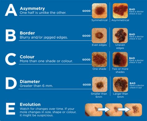 The ABCDE's of Early Detection – CSCF