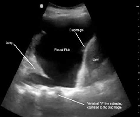 Pleural Effusion On Ultrasound