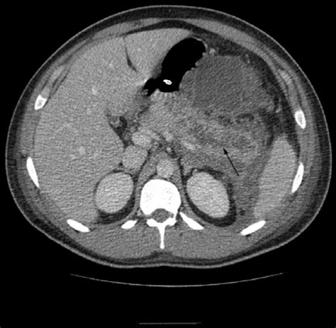 Pancreatic necrosis (arrow points at the area of necrosis). | Download ...