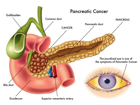 2019 Pancreatic Cancer Statistics in America vs Other Cancers