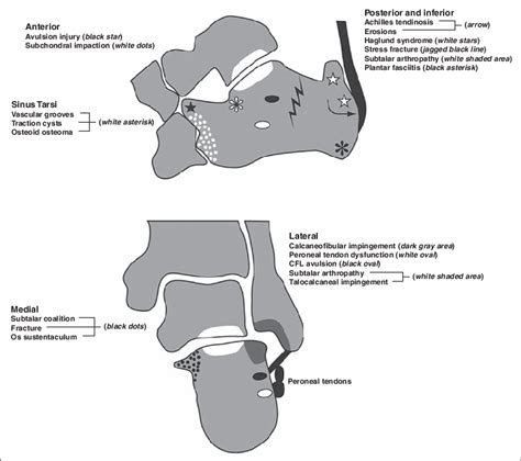 Drawings depict various causes of bone marrow edema in calcaneus ...