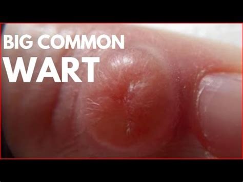 Big common wart in finger. - YouTube