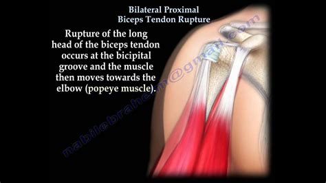 Bilateral Proximal Biceps Tendon Rupture - Everything You Need To Know ...