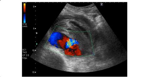 Doppler ultrasound of the right external iliac artery showing a 10.6 × ...