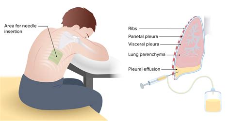 Pleural Effusion Pleural Effusion Antibiotics For Pneumonia Treatment ...