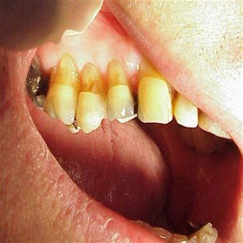 The Signs And Symptoms Of Toothbrush Abrasion | Registered dental ...