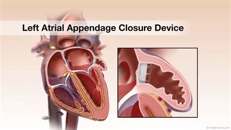 Does Everyone Have A Left Atrial Appendage