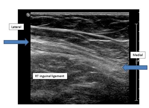 Inguinal Hernia On Ultrasound | Images and Photos finder