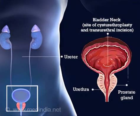 You Have Bladder Neck Dyssynergia. What Exactly is That?