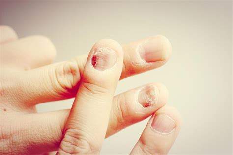 Nail fungal infection: Causes, treatment, and symptoms