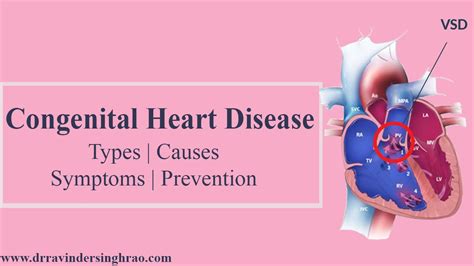 Congenital Heart Disease- Types | Causes | Symptoms | Prevention