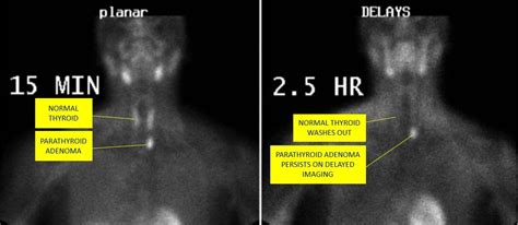 Parathyroid scan adenoma example labeled | Nuclear medicine, Nuclear ...