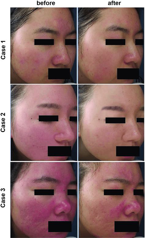 Rosacea Sciton Before And After