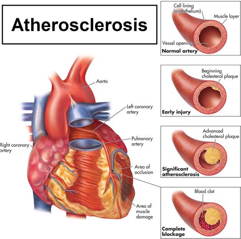 Atherosclerosis - Causes, Risk Factors, Symptoms, Diagnosis & Treatment