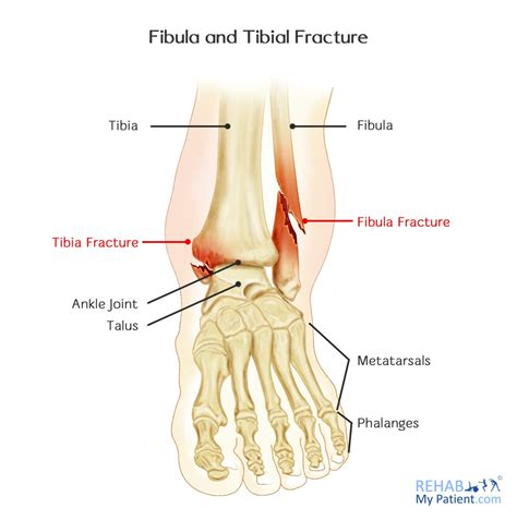 Fibula and Tibial Fracture | Rehab My Patient