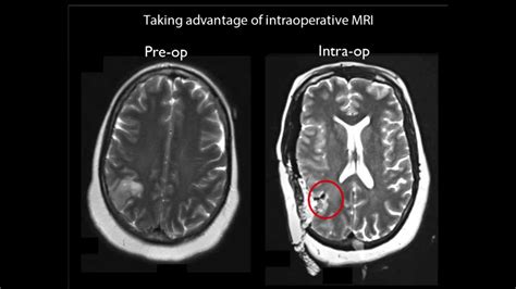 Brain Mri Scan Tumor