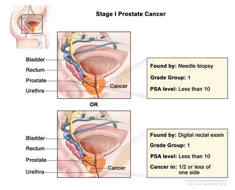 Prostate Cancer Treatment (PDQ®) - NCI