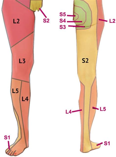 Sciatica - What is it? What causes it? What do I do if I have it ...