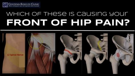 5 Possible Causes for Pain at the Front of the Hip | Stem Cell Blog