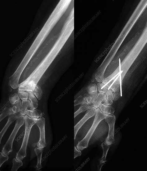 Colles Fracture X Ray