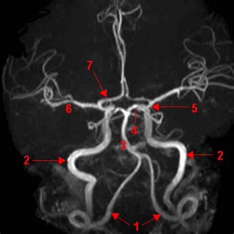 Circle of Willis (MRI - Axial) Diagram | Quizlet