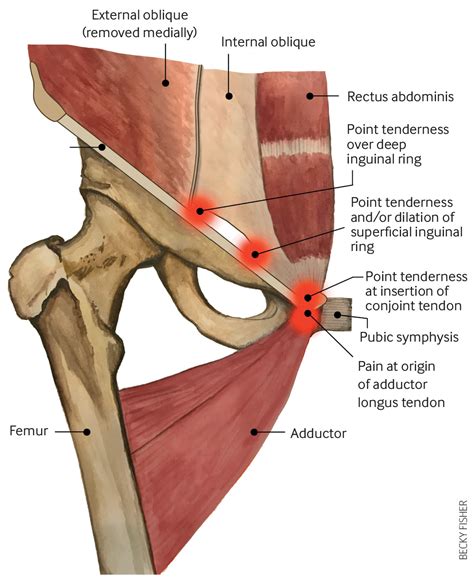 Common Causes of Groin Pain: When to Seek Chiropractic Care | Hyperhealth