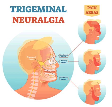 Trigeminal Neuralgia Symptoms, Postherpetic Neuralgia, Essential Oil ...