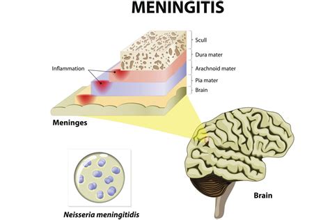 The 3 Pathogens That Cause Meningitis