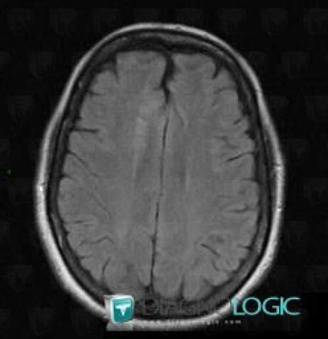 Radiology case : Cerebral infarction (MRI) - Diagnologic